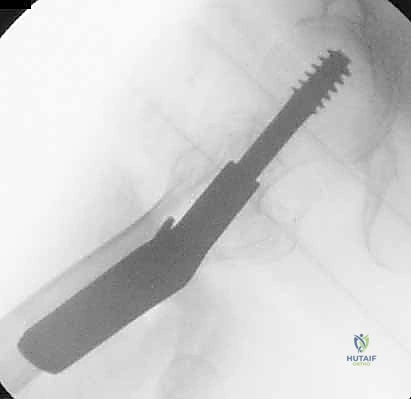 تثبيت المسامير القفلية