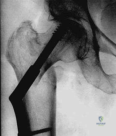 Illustration of peritrochanteric hip fractures - Dr. Mohammed Hutaif