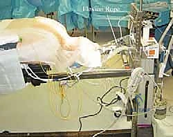 الانزلاق الغضروفي العنقي المسبب للألم