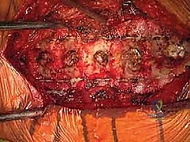 التخطيط الجراحي قبل عملية الفقرات العنقية