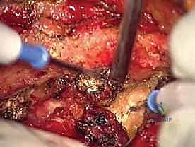 الأستاذ الدكتور محمد هطيف أثناء الجراحة الميكروسكوبية