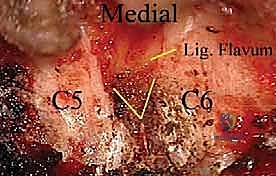 استخدام الميكروسكوب الجراحي لإزالة الضغط