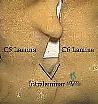 أحدث التقنيات الطبية في جراحة العمود الفقري بصنعاء