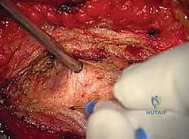 الشق الجراحي الدقيق في خلف الرقبة