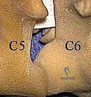 صورة توضيحية لـ ثقب الفقرات العنقية الخلفي: حل فعال لضغط الأعصاب العنقية مع الأستاذ الدكتور محمد هطيف في صنعاء