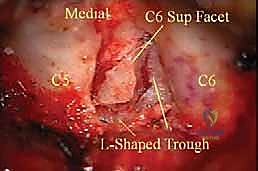 العلاج الطبيعي والتأهيل بعد جراحة الرقبة