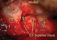 صورة توضيحية لـ ثقب الفقرات العنقية الخلفي: حل فعال لضغط الأعصاب العنقية مع الأستاذ الدكتور محمد هطيف في صنعاء