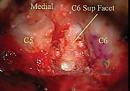 إغلاق الجرح التجميلي بعد العملية
