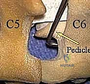 صورة توضيحية لـ ثقب الفقرات العنقية الخلفي: حل فعال لضغط الأعصاب العنقية مع الأستاذ الدكتور محمد هطيف في صنعاء