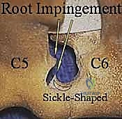 أعراض انضغاط العصب العنقي وضعف الذراع