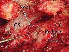 توسيع الثقبة الفقرية وتخفيف الضغط