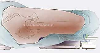 الخطوات الجراحية المعقدة