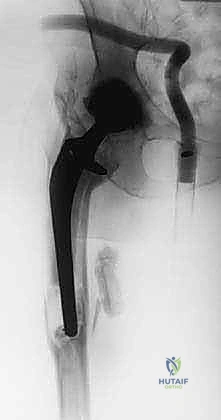 إعادة بناء الأنسجة الرخوة