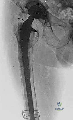 جراحة استبدال مفصل الورك الكلي المراجع