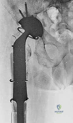 التشريح المعقد للورك