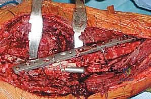 جراحة استبدال مفصل الورك الكلي المراجع مع استبدال الجزء العلوي من الفخذ: حلول متقدمة لفقدان العظم الشديد