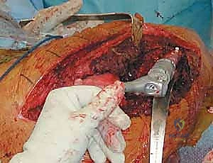 صورة توضيحية لـ جراحة استبدال مفصل الورك الكلي المراجع مع استبدال الجزء العلوي من الفخذ: حلول متقدمة لفقدان العظم الشديد