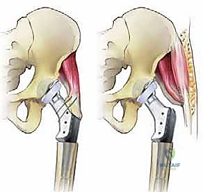 تقييم فقدان العظم
