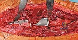 المكونات المعيارية للطرف الاصطناعي