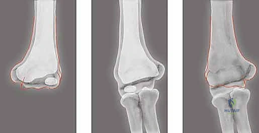 تخطيط ما قبل الجراحة لعملية قطع العظم فوق اللقمة باستخدام التقنيات الحديثة