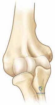 الأشعة السينية وقياس زاوية بومان قبل الجراحة لتحديد درجة التشوه