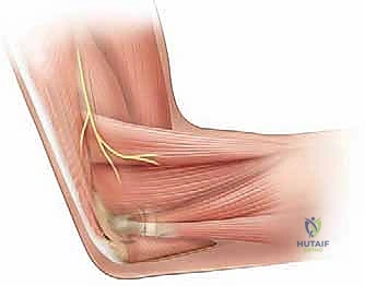 تثبيت العظم باستخدام الأسلاك المعدنية (K-wires) بعد التعديل الجراحي