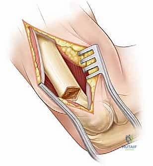 خطوات إجراء القطع العظمي وتثبيت المرفق بدقة عالية