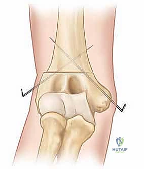 التحقق من استقامة الذراع والمحاذاة الصحيحة أثناء العملية باستخدام جهاز الأشعة المرئي