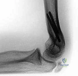 صورة توضيحية لـ عملية قطع العظم فوق اللقمة لتصحيح تقوس المرفق (Cubitus Varus) عند الأطفال: دليل شامل