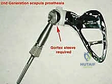 صورة توضيحية لـ استئصال الكتف الكلي وإعادة البناء بالطرف الاصطناعي: دليل شامل للمرضى مع الأستاذ الدكتور محمد هطيف