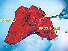 الخزعة الطبية لتحديد نوع الورم في الكتف