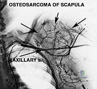 صورة طبية: استئصال الكتف الكلي وإعادة البناء بالطرف الاصطناعي: دليل شامل للمرضى مع الأستاذ الدكتور محمد هطيف