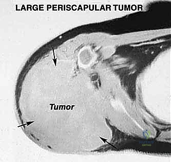 صورة طبية: استئصال الكتف الكلي وإعادة البناء بالطرف الاصطناعي: دليل شامل للمرضى مع الأستاذ الدكتور محمد هطيف