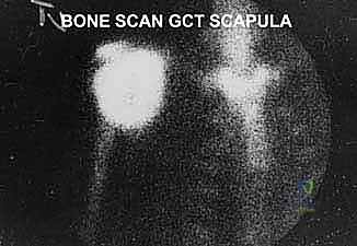 صورة توضيحية لـ استئصال الكتف الكلي وإعادة البناء بالطرف الاصطناعي: دليل شامل للمرضى مع الأستاذ الدكتور محمد هطيف