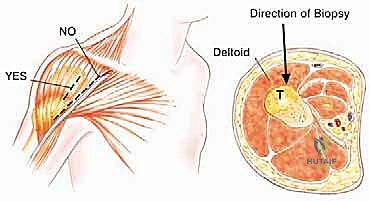 صورة طبية: استئصال الكتف الكلي وإعادة البناء بالطرف الاصطناعي: دليل شامل للمرضى مع الأستاذ الدكتور محمد هطيف