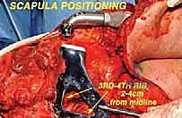 صورة توضيحية لـ استئصال الكتف الكلي وإعادة البناء بالطرف الاصطناعي: دليل شامل للمرضى مع الأستاذ الدكتور محمد هطيف