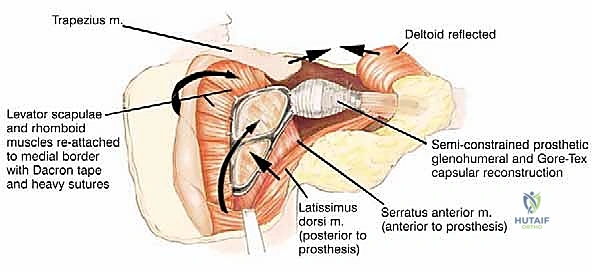 صورة توضيحية لـ استئصال الكتف الكلي وإعادة البناء بالطرف الاصطناعي: دليل شامل للمرضى مع الأستاذ الدكتور محمد هطيف