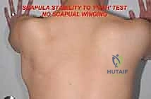 Illustration of total scapular resections - Dr. Mohammed Hutaif