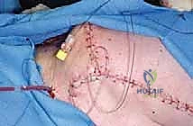 صورة طبية: استئصال الكتف الكلي وإعادة البناء بالطرف الاصطناعي: دليل شامل للمرضى مع الأستاذ الدكتور محمد هطيف