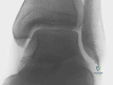 تثبيت مفصل الكاحل بالمنظار: حل دائم لآلام التهاب المفصل المزمنة في صنعاء مع الأستاذ الدكتور محمد هطيف