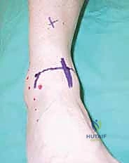 الفرق بين الجراحة المفتوحة وتثبيت الكاحل بالمنظار