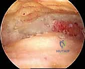التخدير والتحضير لعملية دمج الكاحل