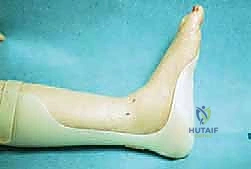 صورة توضيحية لـ تثبيت مفصل الكاحل بالمنظار: حل دائم لآلام التهاب المفصل المزمنة في صنعاء مع الأستاذ الدكتور محمد هطيف