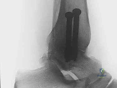 صورة توضيحية لـ تثبيت مفصل الكاحل بالمنظار: حل دائم لآلام التهاب المفصل المزمنة في صنعاء مع الأستاذ الدكتور محمد هطيف