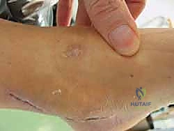 صورة توضيحية لـ تثبيت مفصل الكاحل بالمنظار: حل دائم لآلام التهاب المفصل المزمنة في صنعاء مع الأستاذ الدكتور محمد هطيف