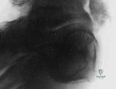 Illustration of arthroscopic ankle arthrodesis - Dr. Mohammed Hutaif