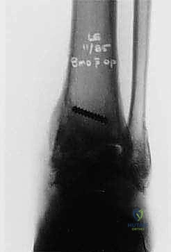 مرحلة التعافي الأولى بعد جراحة الكاحل