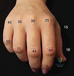 Digital & Thumb Joint Arthrodesis: An Intraoperative Masterclass