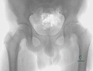 التشريح الدقيق لمفصل الورك وصفيحة النمو