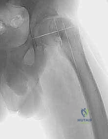صورة توضيحية لـ قطع العظم الانثنائي بين المدورين لعلاج انزلاق رأس الفخذ المشاشي الشديد